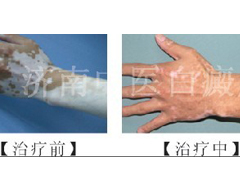 手指上的白癜风如何才能治好？