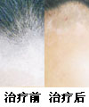 白癜风典型治疗病例（10）