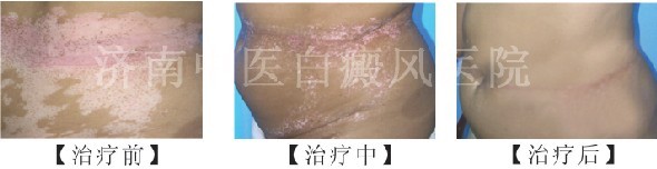 白癜风治疗前后